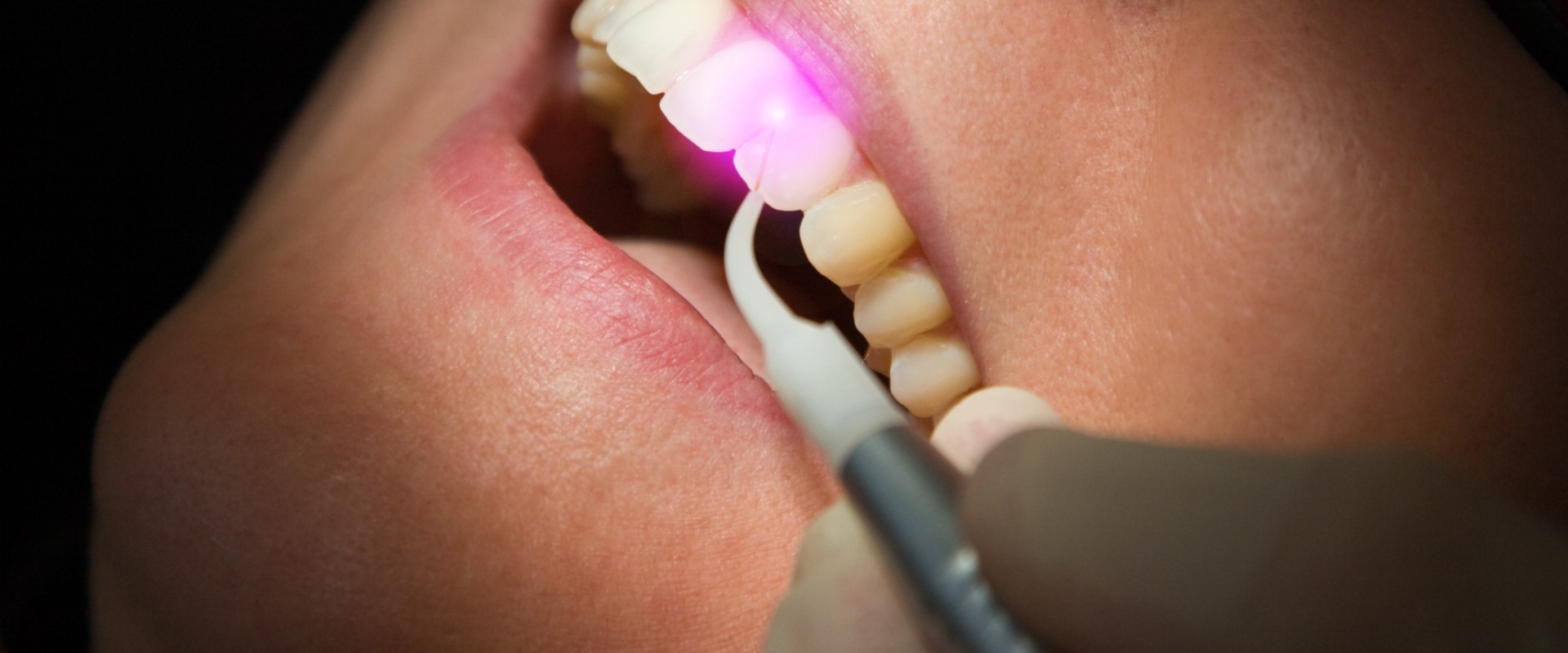 what-to-avoid-after-laser-dental-treatment