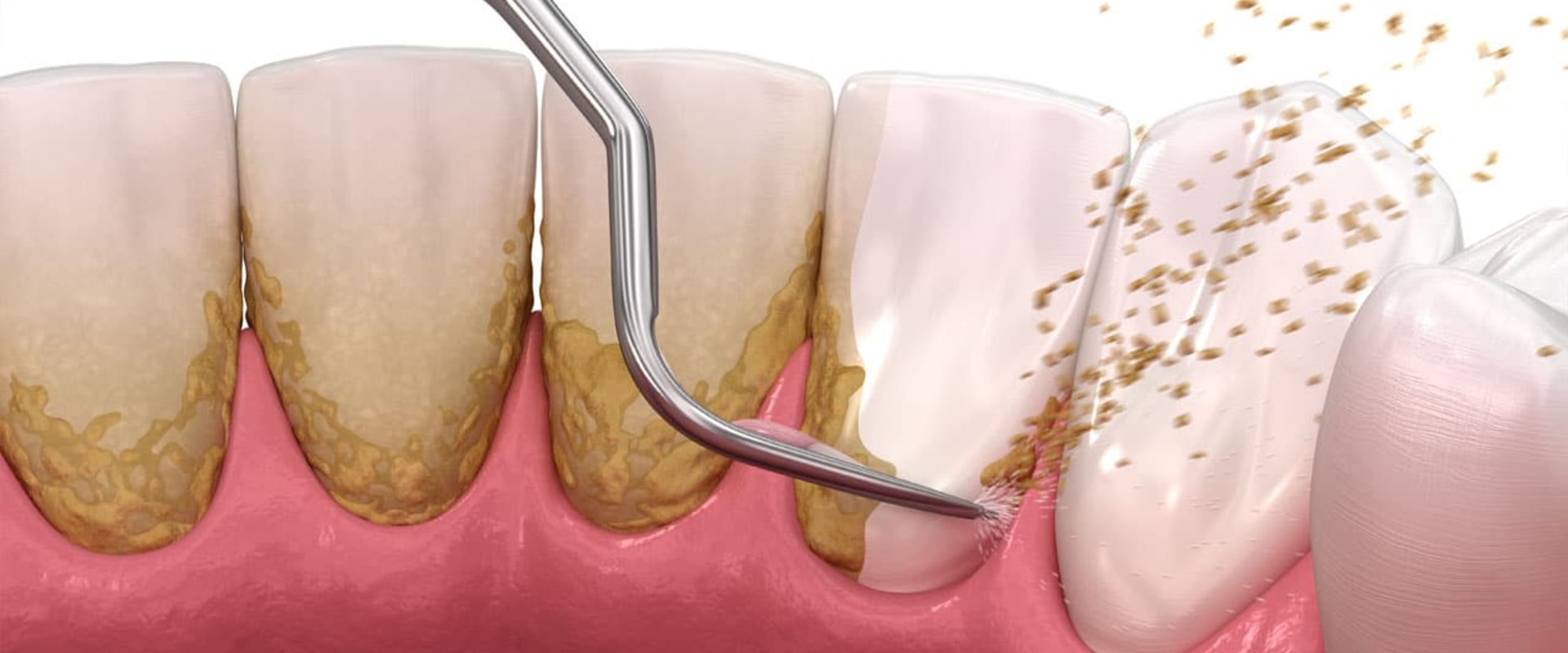 Can Laser Cleaning Help with Tartar Buildup?