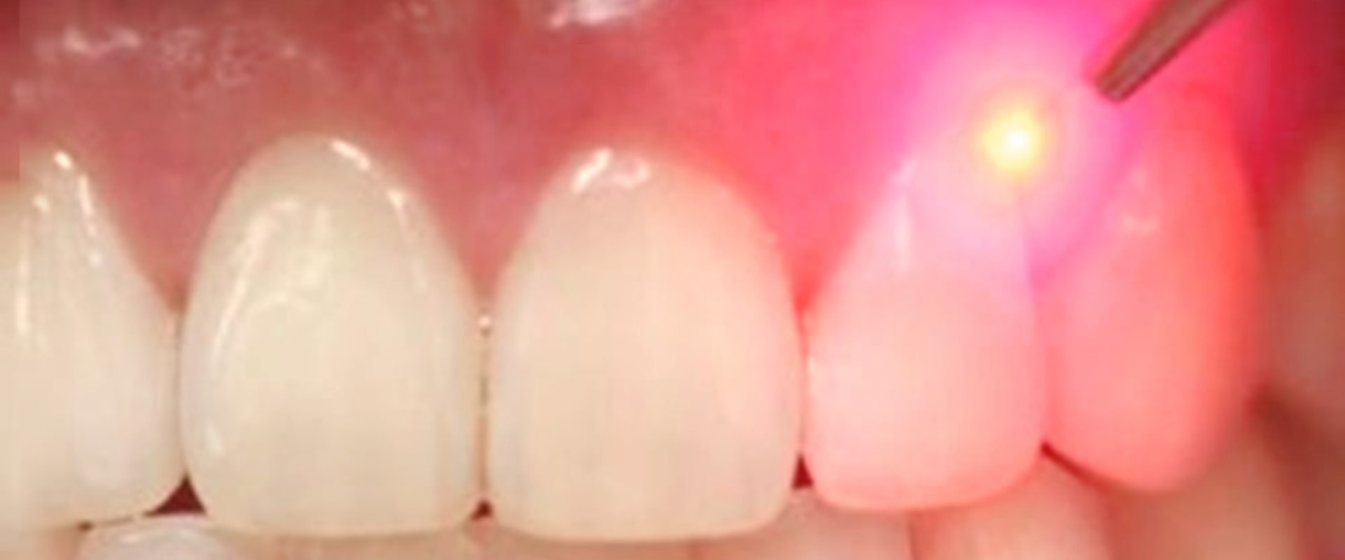 how-long-do-the-results-of-a-dental-laser-cleaning-last