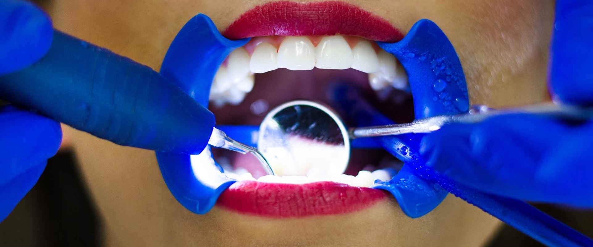 why-you-should-choose-dental-laser-cleaning-for-your-next-appointment